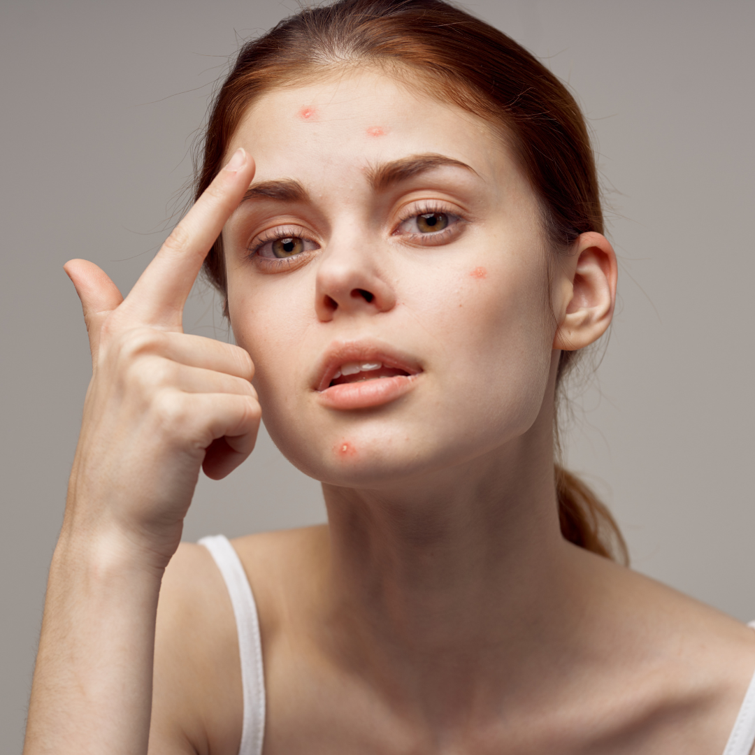 Hormonal Skin &amp; Breakouts