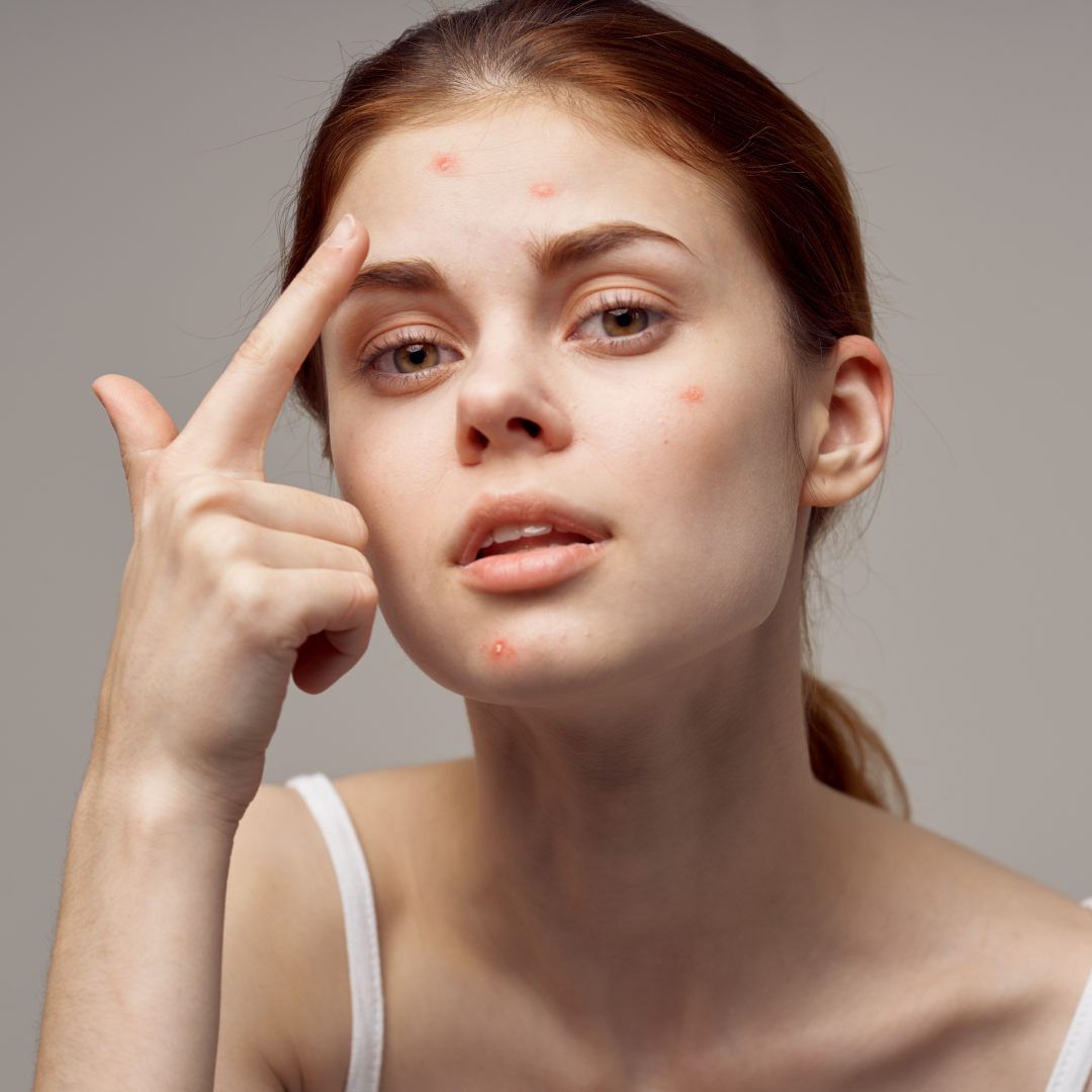 Hormonal Skin & Breakouts